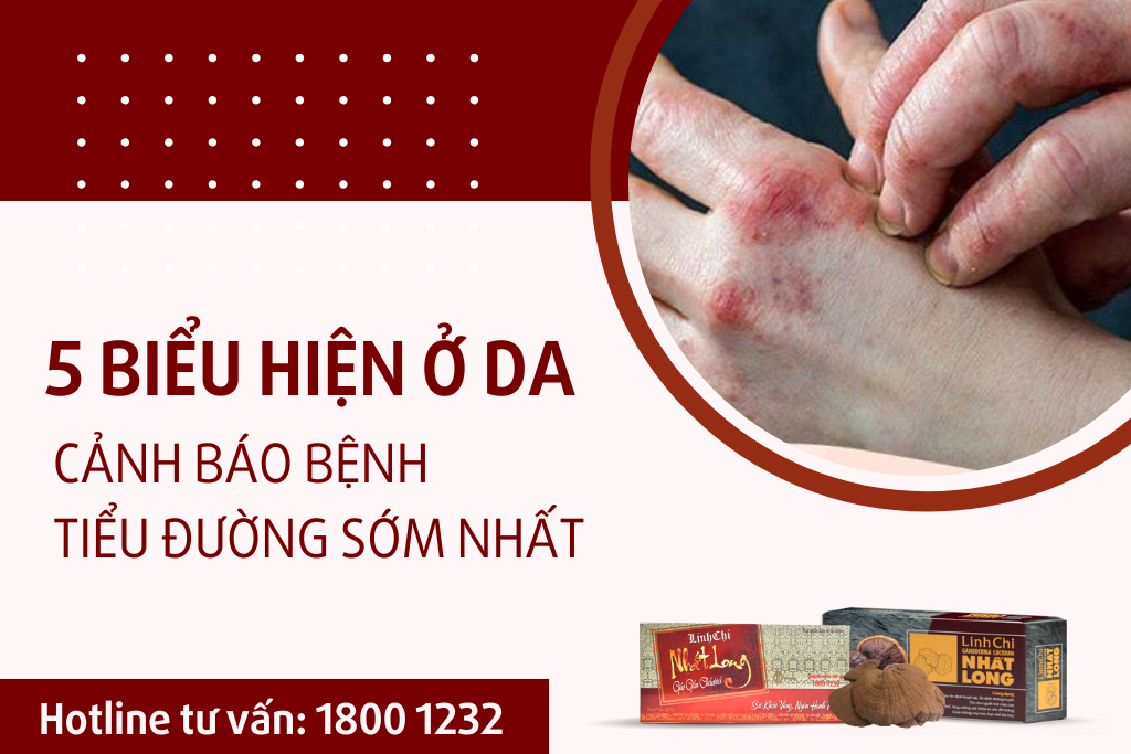 5 Biểu Hiện Trên Da Cảnh Báo Bệnh Tiểu Đường Sớm Nhất
